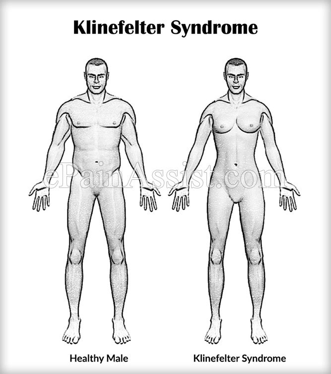 klinefelter-syndrome.jpg