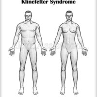 klinefelter-syndrome.jpg