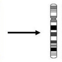 trisomia18_2.jpg